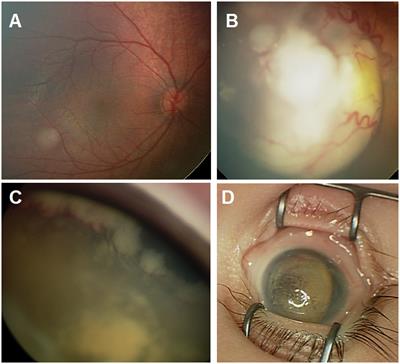 Causes of death and survival analysis for patients with retinoblastoma in Jordan